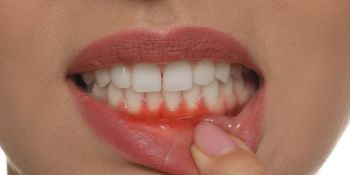 Treating bleeding gums & gum disease